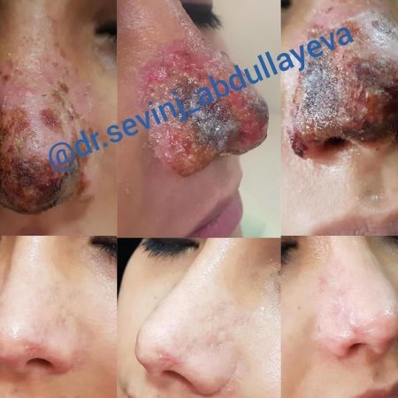 Azərbaycanda kosmetoloq qızın burnunu inanılmaz hala saldı – Fotolar (18+)