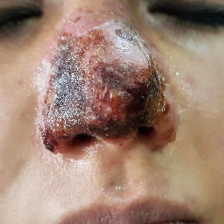 Azərbaycanda kosmetoloq qızın burnunu inanılmaz hala saldı – Fotolar (18+)