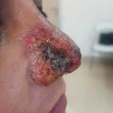 Azərbaycanda kosmetoloq qızın burnunu inanılmaz hala saldı – Fotolar (18+)