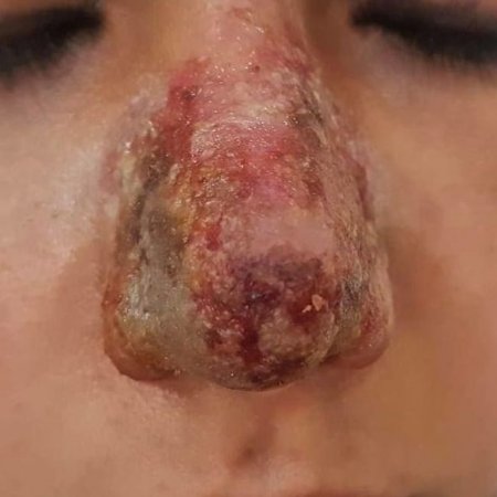 Azərbaycanda kosmetoloq qızın burnunu inanılmaz hala saldı – Fotolar (18+)